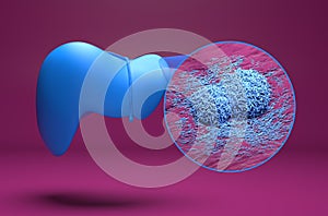 Liver cancer - isometric view 3d illustration photo