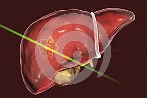 Liver cancer treatment with laser