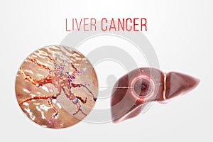 Liver cancer, tumor, human anatomy. Concept health care, disease, medicine, biology, chemotherapy. 3D rendering, 3D illustration, photo