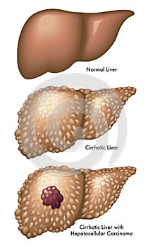 Liver with cirrhosis and carcinoma photo