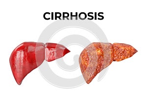 Liver cirrhosis is a chronic inflammation of the liver, a fibrous tissue replaces normal liver tissue, blocking blood flow