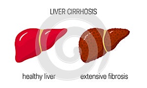 Liver cirrhosis concept photo