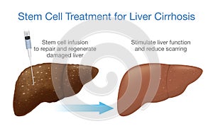 Liver cirrhosis treatment with stem cells.