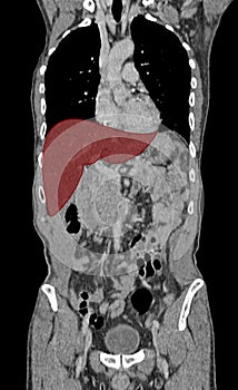 Liver on computed tomography