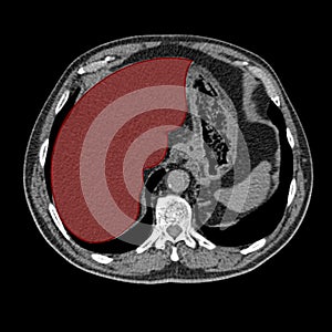 Liver on computed tomography photo