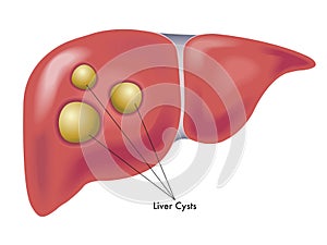 Liver cysts