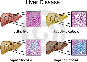 Liver Disease photo