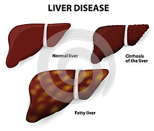 Liver Disease