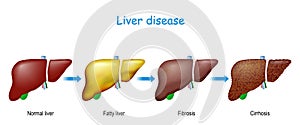 Liver disease. From healthy internal organ to Fatty liver, fibrosis, and Cirrhosis photo