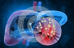 Liver disease. Liver infection. Viral infection