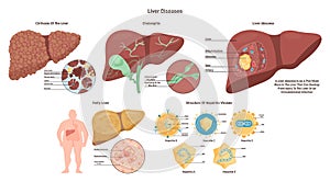 Liver diseases set. Hepatic system organ pathology. Liver damage