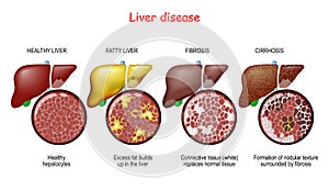 Liver diseases. Stages of liver damage