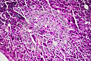 Liver edema, light micrograph