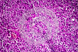 Liver edema, light micrograph