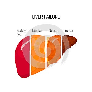 Liver failure vector concept photo