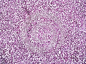 Liver fatty hepatosis of a human