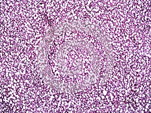 Liver fatty hepatosis of a human photo