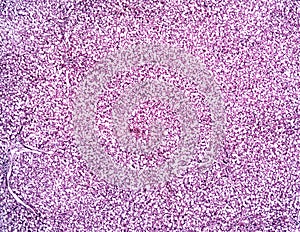 Liver fatty hepatosis of a human photo
