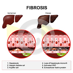 Liver fibrosis photo