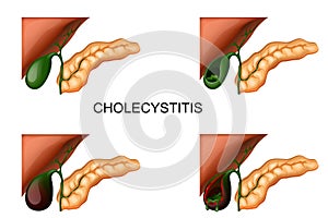 Liver, gall bladder and pancreas. cholecystitis photo