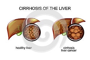 The liver healthy and the patient with cirrhosis photo