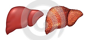 Liver of healthy person. Liver patients with hepatitis. Liver is sick person. Cirrhosis of liver. Repercussion alcoholism