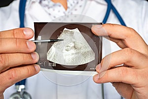 Liver hematoma  on ultrasound image concept photo. Doctor indicating by pointer on printed picture of ultrasound pathology of live