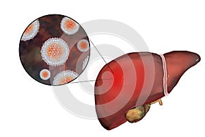 Liver with Hepatitis C infection