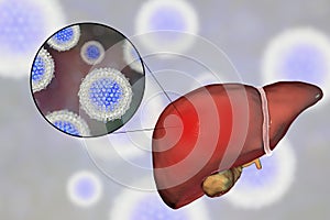 Liver with Hepatitis C infection and close-up view of Hepatitis C Virus