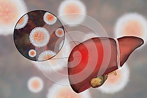 Liver with Hepatitis C infection and close-up view of Hepatitis C Virus