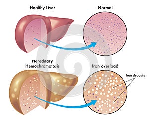 Liver with hereditary hemochromatosis