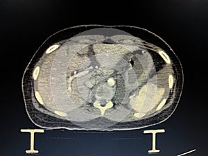 Liver laceration with Hemoperitonium photo