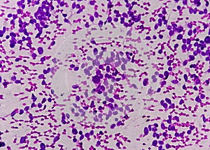 Liver Non Hodgkin lymphoma. Metastatic carcinoma. photo