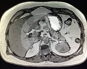Liver pancreas mri pathology cholangiogram exam