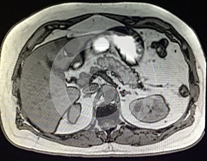 Liver pancreas mri pathology cholangiogram exam