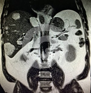 Liver pancreas mri pathology cholangiogram exam