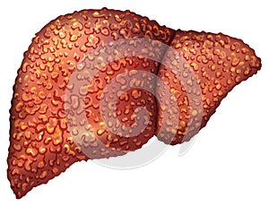 Liver patients with hepatitis. Liver is sick person. Cirrhosis of liver. Repercussion alcoholism