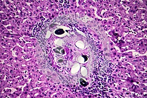 Liver schistosomiasis, light micrograph photo