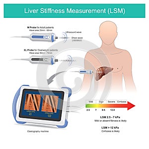 Liver Stiffness Measurement. Measuring tissue liver stiffness in patients by using the reflection sound waves for diagnose of