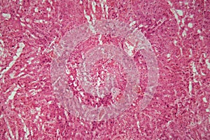 Liver tissue with Amyloidosis under a microscope