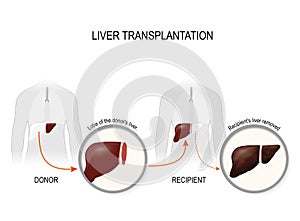 Liver transplantation or hepatic transplantation photo