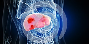 Liver tumors