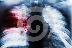 Lobar Pneumonia