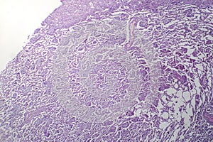 Lobar pneumonia in dissolved dissipate period, light micrograph