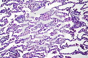 Lobar pneumonia in dissolved dissipate period, light micrograph