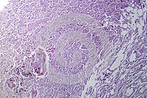 Lobar pneumonia in dissolved dissipate period, light micrograph photo