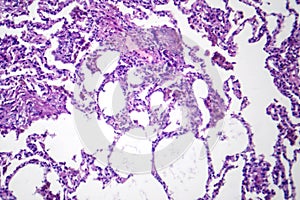 Lobar pneumonia in dissolved dissipate period, light micrograph photo