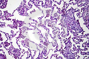 Lobar pneumonia in dissolved dissipate period, light micrograph photo