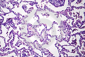 Lobar pneumonia in dissolved dissipate period, light micrograph photo