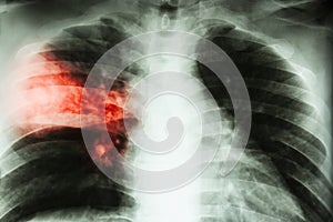 Lobar pneumonia . film chest x-ray show alveolar infiltration at right middle lobe due to tuberculosis infection .